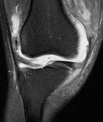 Figure 5 for case Patellar dislocation